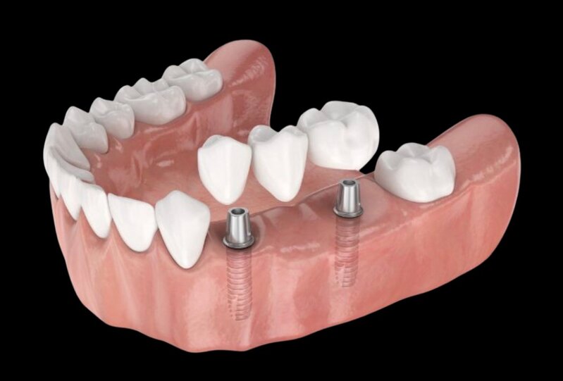Caso clínico de implante dental con corona atornillada