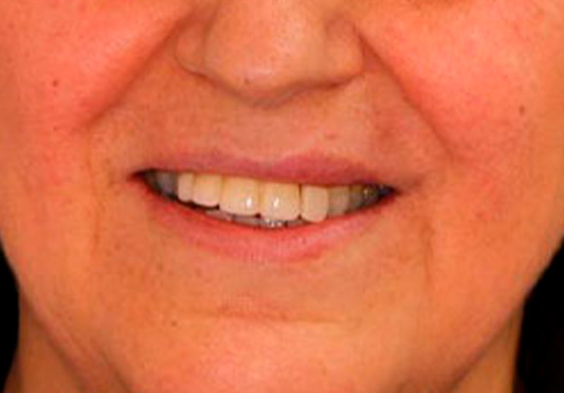 Caso clínico de prótesis fija plural: puente dental de cerámica