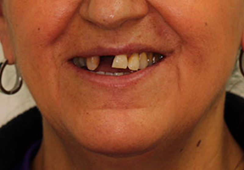 Caso clínico de prótesis fija plural: puente dental terminado