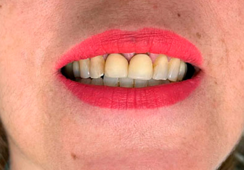 Caso clínico de prótesis fija unitaria: corona dental sobre pieza restaurada
