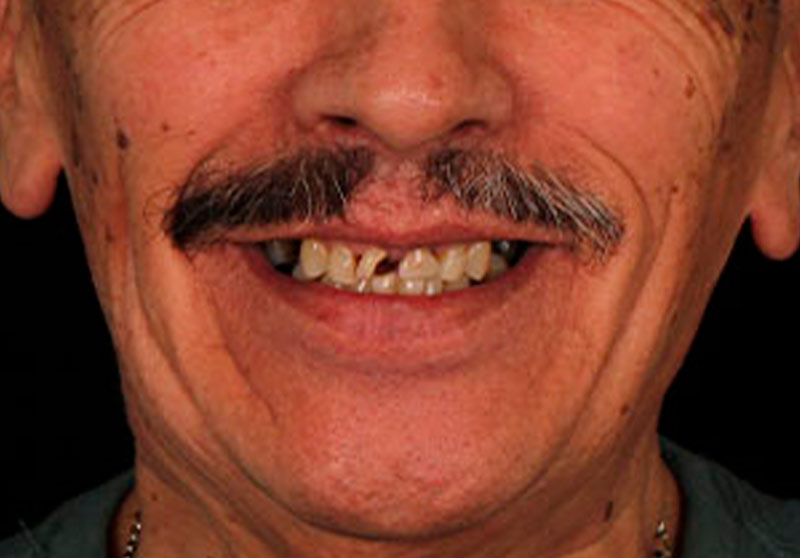 Caso clínico de prótesis fija unitaria: corona dental de cerámica