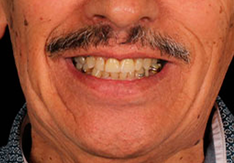 Caso clínico de prótesis fija unitaria: corona dental instalada