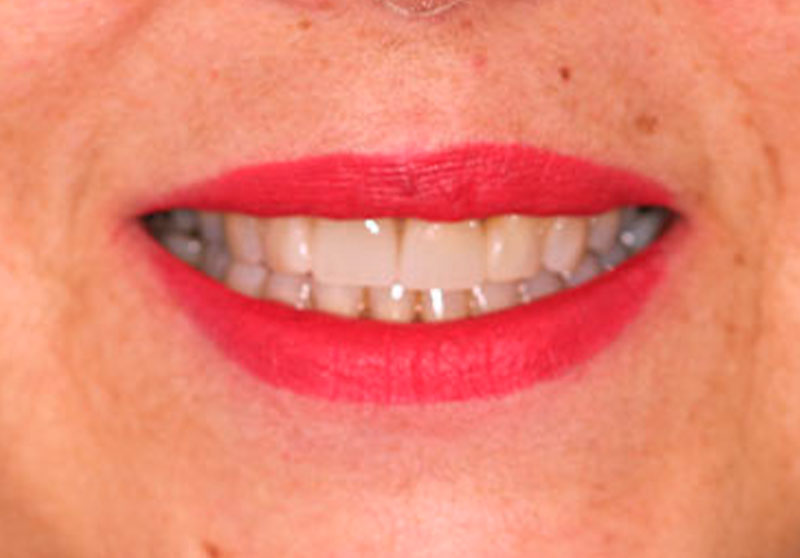 Caso clínico de prótesis fija unitaria: corona dental terminada