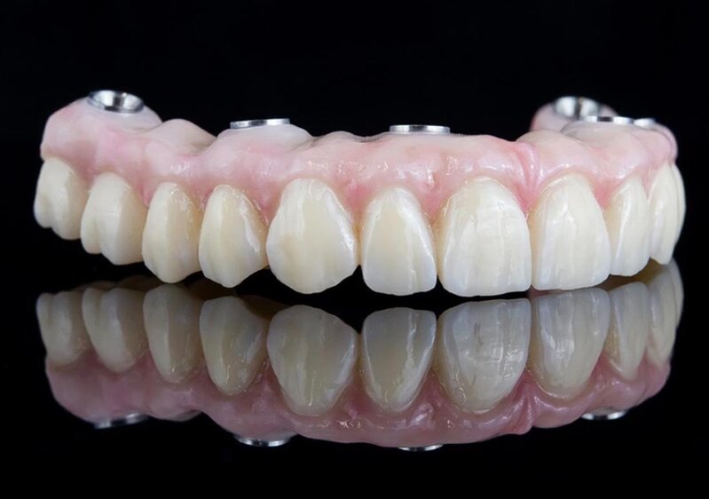Caso clínico de prótesis híbrida fija sobre implantes
